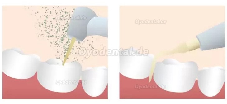 Refine MaxSurgery Geräte für Piezochirurgie Zahnarzt Ultraschall-Piezo-Knochenchirurgiesystem