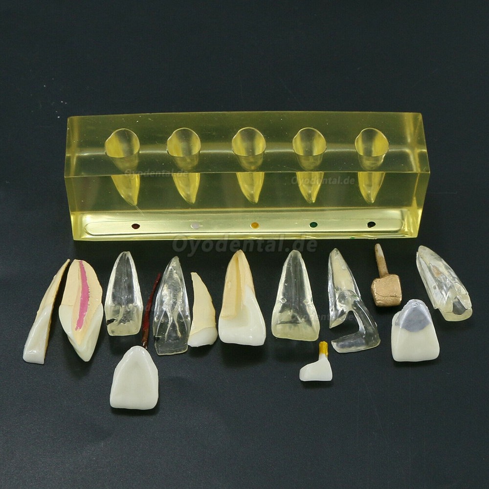 Zahnzähne Modell 5 Stufen Demonstration Endodontische Behandlung Wurzelkanal Schneidezahn