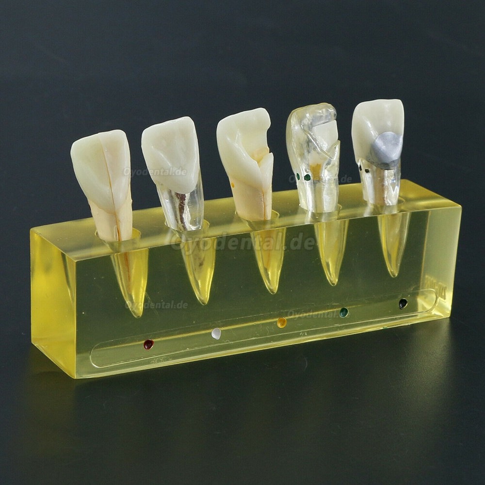 Zahnzähne Modell 5 Stufen Demonstration Endodontische Behandlung Wurzelkanal Schneidezahn