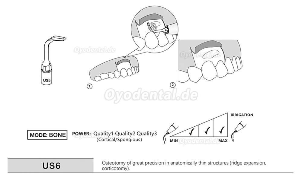 1 Stück Piezochirurgische Ansätze Spitzen US1 US1L US1R US2 US3 US4 US5 US6 US7 US11 US12 für Knochenschneiden Sinus lif