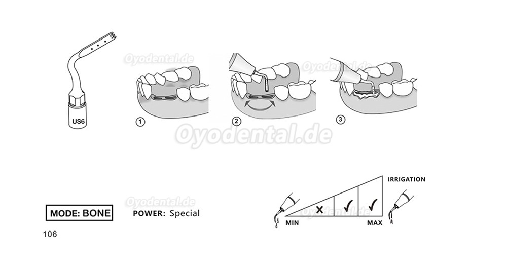 1 Stück Piezochirurgische Ansätze Spitzen US1 US1L US1R US2 US3 US4 US5 US6 US7 US11 US12 für Knochenschneiden Sinus lif