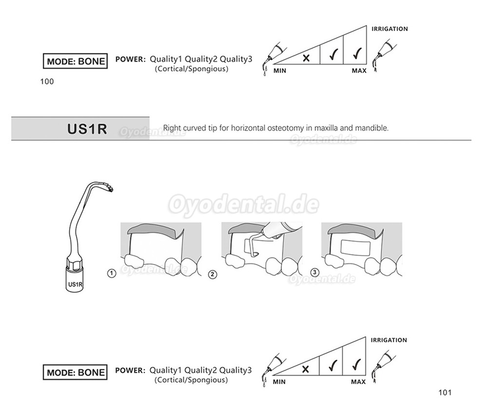 1 Stück Piezochirurgische Ansätze Spitzen US1 US1L US1R US2 US3 US4 US5 US6 US7 US11 US12 für Knochenschneiden Sinus lif