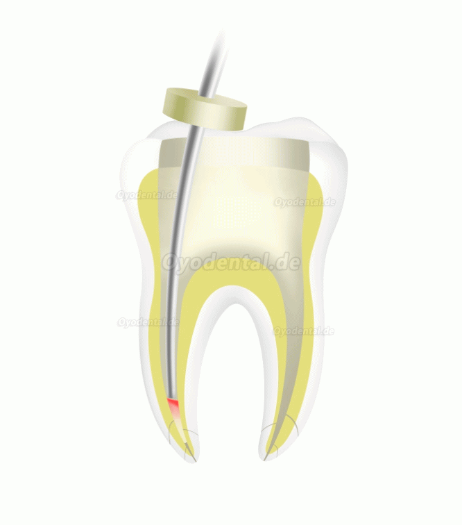 Woodpecker Fi-P Dental Wireless Guttapercha-Endo-Obturationsstift